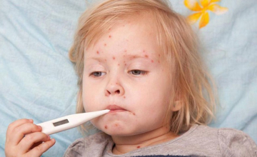 წითელას შემთხვევების მნიშვნელოვანია მატებაა დაფიქსირებული – ჩხაიძე