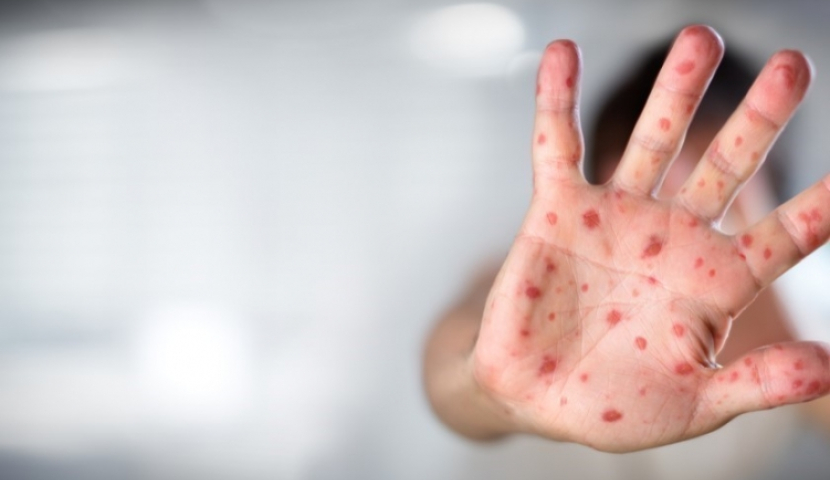 „შესაძლებელია შემოდგომაზე წითელამ ისევ იფეთქოს“, - დაავადებათა კონტროლის ცენტრი