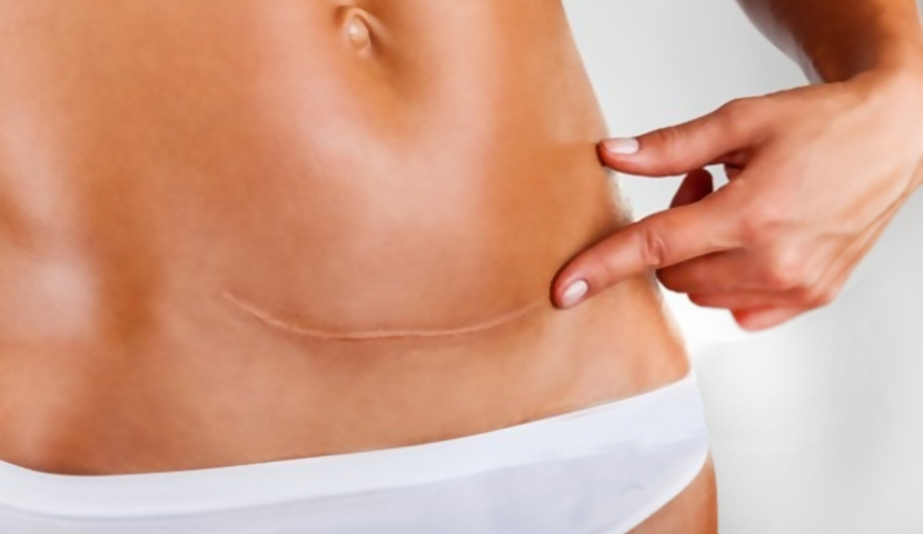 ჯანდაცვის მინისტრის თქმით, საკეისრო კვეთის გაზრდილი რაოდენობის გამო, მოსალოდნელია დემოგრაფიული პრობლემების შექმნა