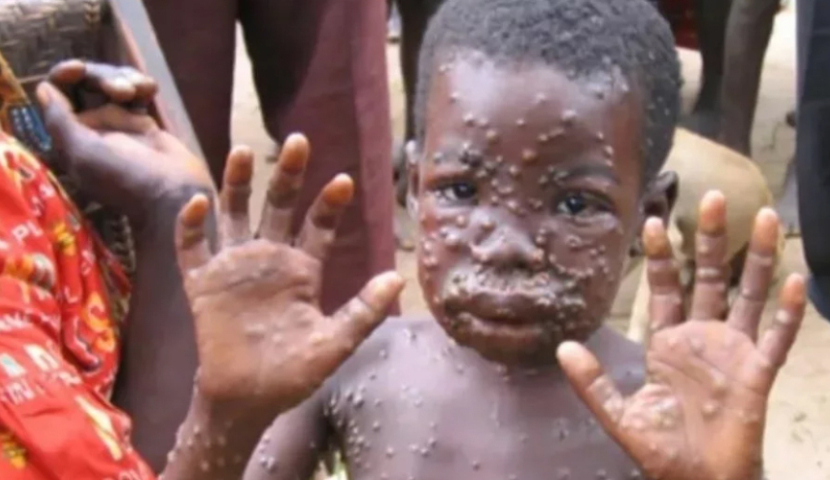 მაიმუნის ყვავილის სამიზნე ჯგუფი ბავშვები და ორსულებია - ბუწაშვილი