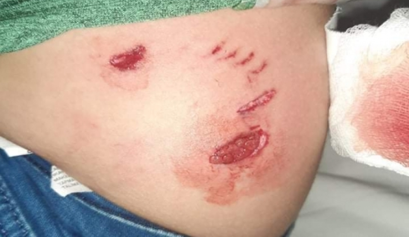 ახალციხეში მიუსაფარმა ძაღლებმა ცხრა არასრულწლოვანი დაკბინეს (ვიდეო)