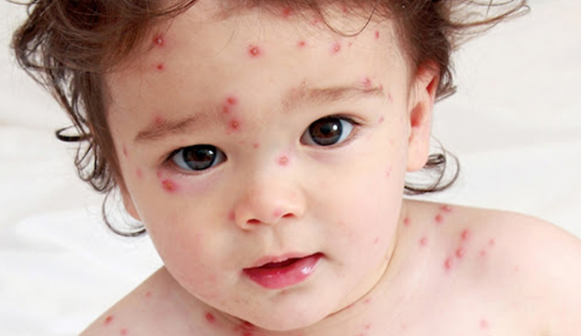 წითელას დიდ აფეთქებას ელიან - ჯანმო