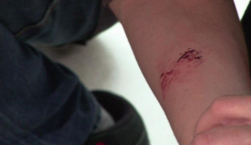 28 სექტემბერი ცოფთან ბრძოლის საერთაშორისო დღეა