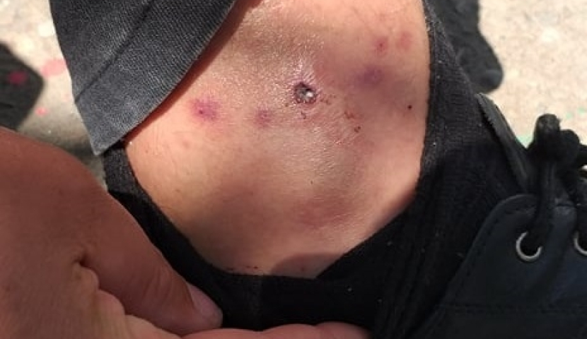 ახალგაზრდა მამაკაცს გველმა უკბინა